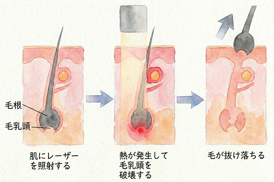 医療レーザー脱毛のメカニズム
